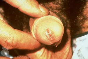 chlamydial_urethritis (1)