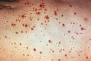 hiv-skin-rashes-pictureshiv-rash-pictures-rash-resource-cq3qcnin
