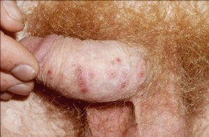 HSV_crusted_lesions